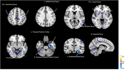 Differences in gut microbiota correlate with symptoms and regional brain volumes in patients with late-life depression